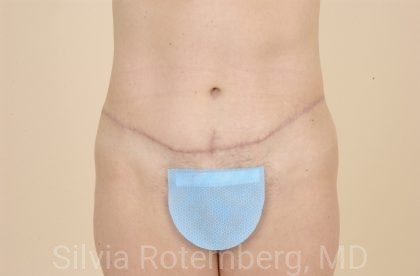 Best Tummy Tuck Miami  Rotemberg Plastic Surgery