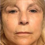 Facelift Before & After Patient #3621