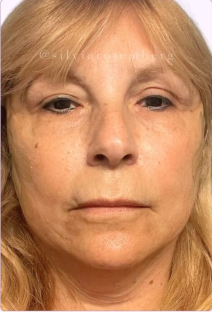 Facelift Before & After Patient #3621