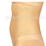 Liposuction 360 Before & After Patient #3619