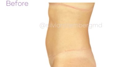 Liposuction 360 Before & After Patient #3619