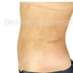 Liposuction 360 Before & After Patient #3619