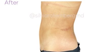 Liposuction 360 Before & After Patient #3619