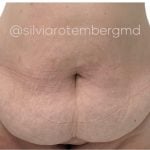 Tummy Tuck Before & After Patient #3618