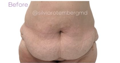 Tummy Tuck Before & After Patient #3618