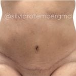 Tummy Tuck Before & After Patient #3618