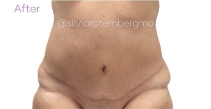 Tummy Tuck Before & After Patient #3618