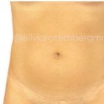 Liposuction 360 Before & After Patient #3619