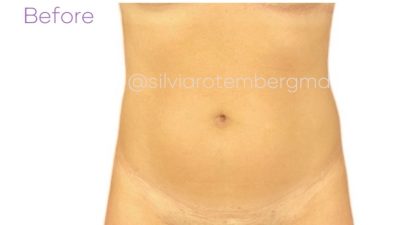 Liposuction 360 Before & After Patient #3619