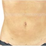 Liposuction 360 Before & After Patient #3619