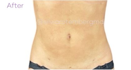 Liposuction 360 Before & After Patient #3619