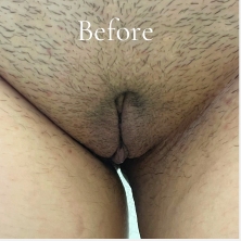 Labiaplasty Before & After Patient #3620