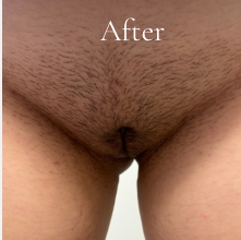 Labiaplasty Before & After Patient #3620