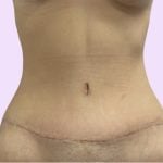 Tummy Tuck Before & After Patient #3626