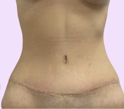 Tummy Tuck Before & After Patient #3626