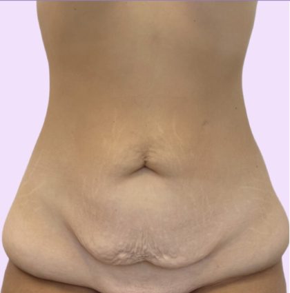 Tummy Tuck Before & After Patient #3626