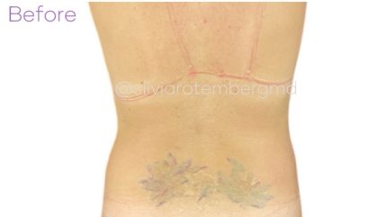 Liposuction 360 Before & After Patient #3619