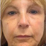 Facelift Before & After Patient #3621