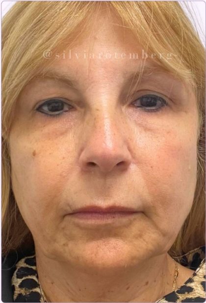 Facelift Before & After Patient #3621