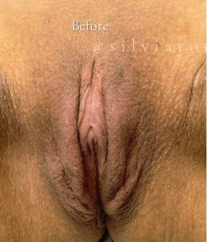 Labiaplasty Before & After Patient #3633