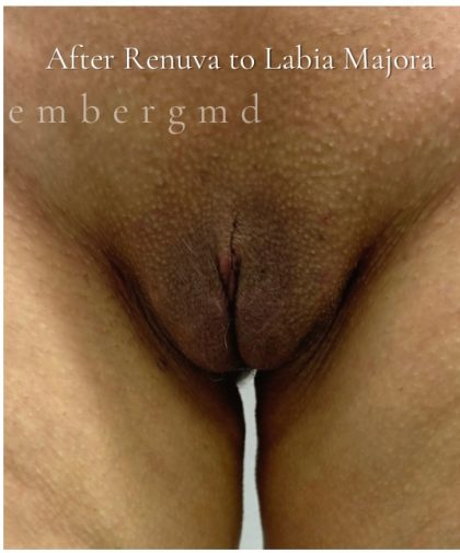 Labiaplasty Before & After Patient #3634